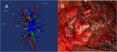 Analysis of pulmonary artery variation based on 3D reconstruction of CT angiography